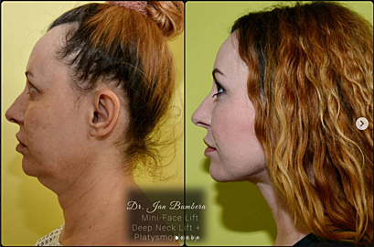 Rejuvenation of the face by a combination of procedures